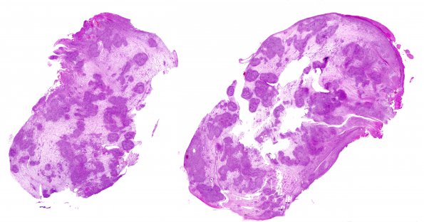 25B1 Schwannoma, nodular (Case 25) H&E WM (2)