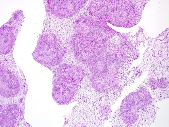 25B2A Schwannoma, nodular (Case 25) H&E 5