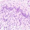 25B3 Schwannoma, nodular (Case 25) H&E 1