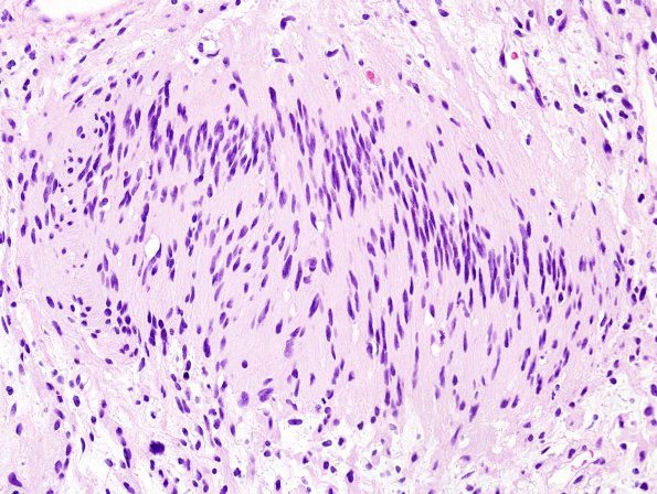 25B3 Schwannoma, nodular (Case 25) H&E 1