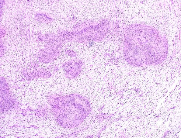 25B4 Schwannoma, nodular (Case 25) H&E 2