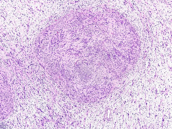 25B5 Schwannoma, nodular (Case 25) H&E 4