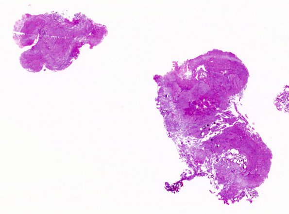 26A1 Schwannoma-Meningioma NF2 pt (Case 26) 1 H&E WM