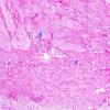 26A2 Schwannoma-Meningioma NF2 pt (Case 26) 1 copy.jpg