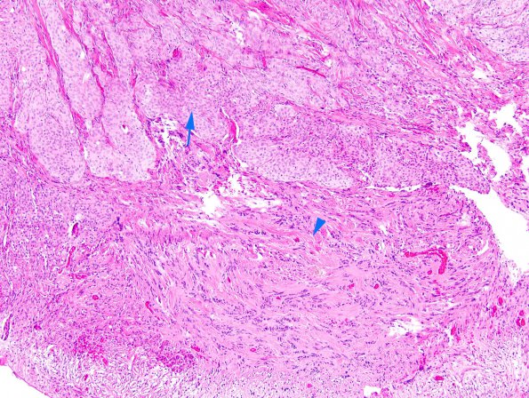 26A2 Schwannoma-Meningioma NF2 pt (Case 26) 1 copy.jpg