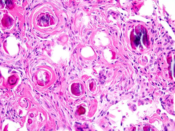 26A3 Schwannoma-Meningioma NF2 pt (Case 26) 2.jpg