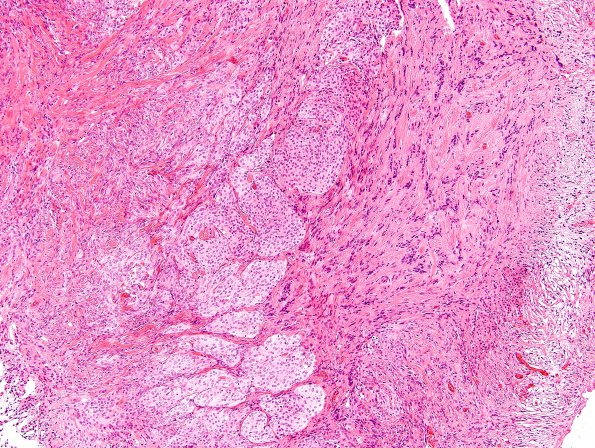 26A4 Schwannoma-Meningioma NF2 pt (Case 26) H&E 2