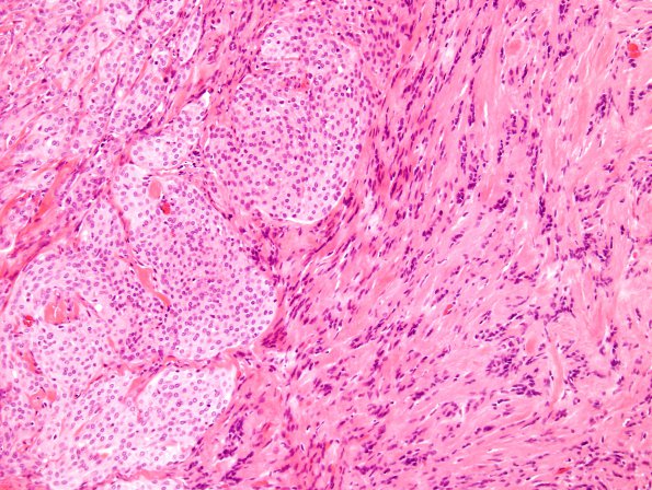 26A5 Schwannoma-Meningioma NF2 pt (Case 26) H&E 1