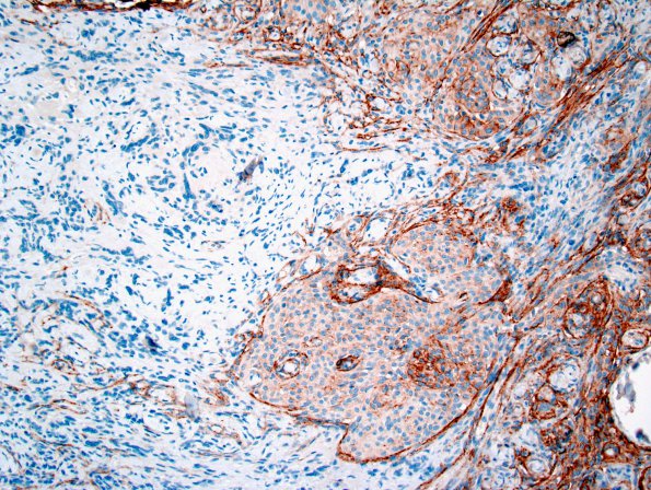 26B2 Schwannoma-Meningioma NF2 pt (Case 26) EMA 1.jpg