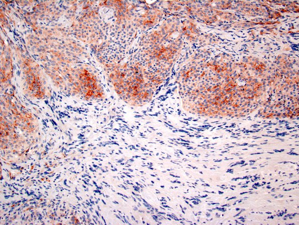 26B3 Schwannoma-Meningioma NF2 pt (Case 26) EMA 2.jpg