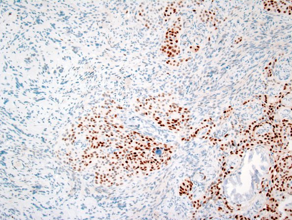 26B4 Schwannoma-Meningioma NF2 pt (Case 26) PR 2.jpg