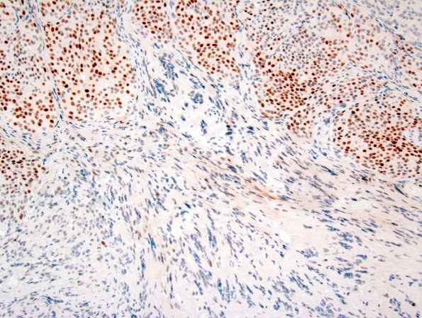 26B5 Schwannoma-Meningioma NF2 pt (Case 26) PR 1.jpg