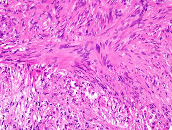 26C1 Schwannoma-Meningioma NF2 pt (Case 26) 3.jpg