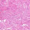 27A1 Schwannoma, prominent bands (Case 27) H&E 1.jpg