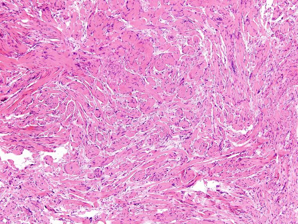 27A1 Schwannoma, prominent bands (Case 27) H&E 1.jpg