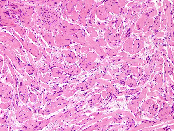 27A2 Schwannoma, prominent bands (Case 27) H&E 2.jpg