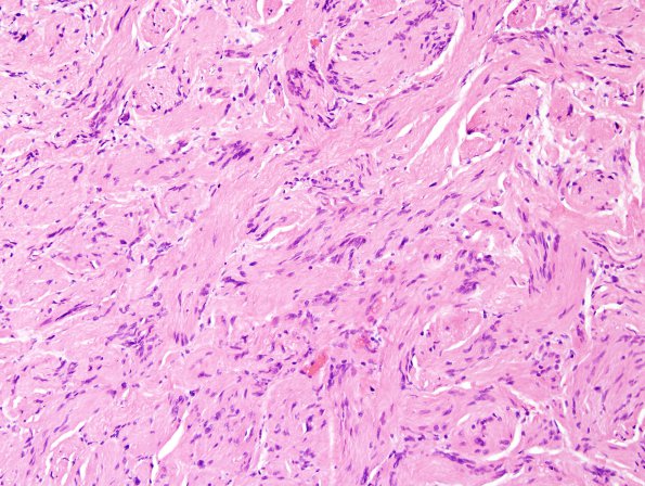 27A3 Schwannoma, prominent bands (Case 27) H&E 3.jpg