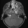 28A Schwannoma-Meningioma Collision NF2 (Case 28) T1W 3 copy