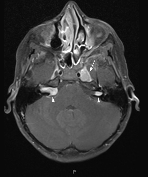 28A Schwannoma-Meningioma Collision NF2 (Case 28) T1W 3 copy