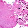 28B1 Schwannoma-Meningioma Collision (Case 28) H&E 4X copy.jpg