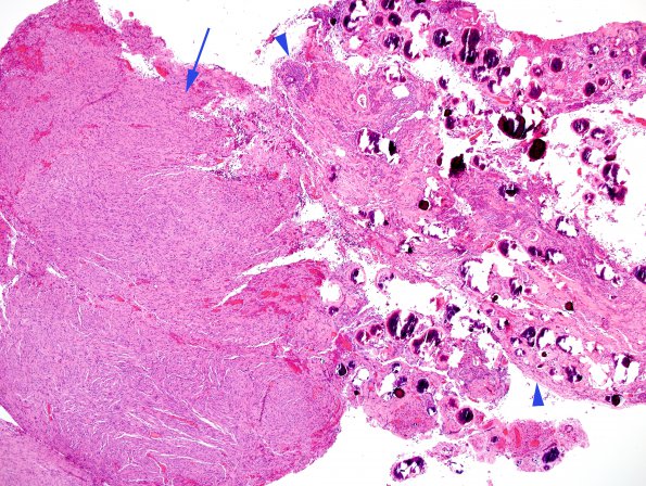 28B1 Schwannoma-Meningioma Collision (Case 28) H&E 4X copy.jpg