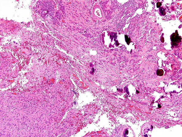 28B2 Schwannoma-Meningioma Collision (Case 28) Area A H&E 10X.jpg