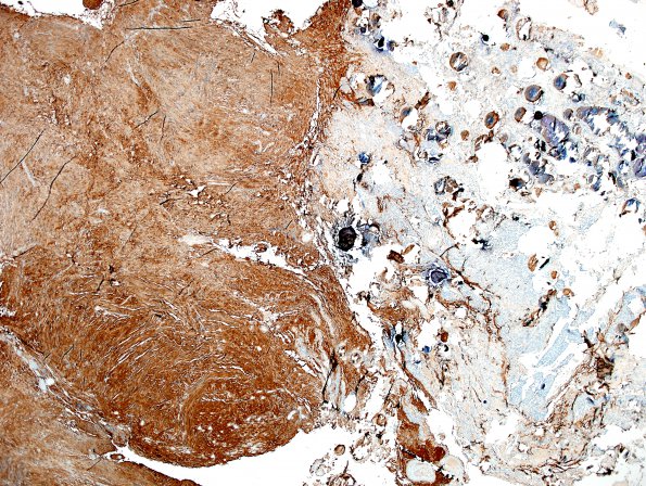 28C Schwannoma-Meningioma Collision (Case 28) S100 4X.jpg