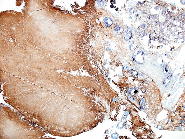 28D1 Schwannoma-Meningioma Collision (Case 28) Coll IV 4X.jpg