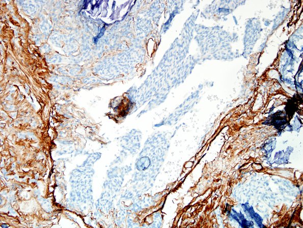 28D2 Schwannoma-Meningioma Collision (Case 28) Area A Coll IV 1.jpg