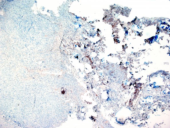 28E Schwannoma-Meningioma Collision (Case 28) EMA 4X.jpg