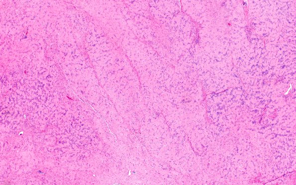 29A1 Schwannoma, lots Verocay (Case 29) H&E 4X