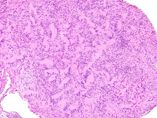 2A1 Schwannoma (Case 2A) H&E 4