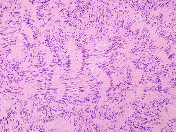 2A2 Schwannoma (Case 2A) H&E 3