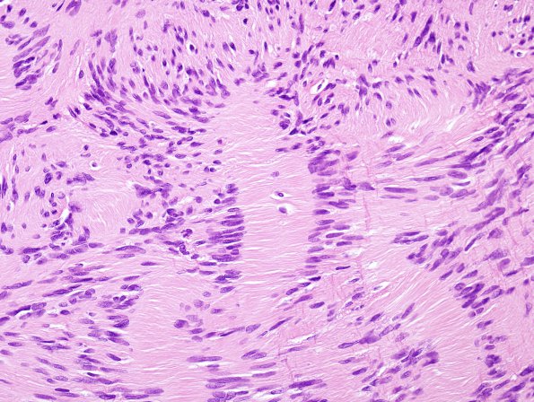 2A3 Schwannoma (Case 2A) H&E 2