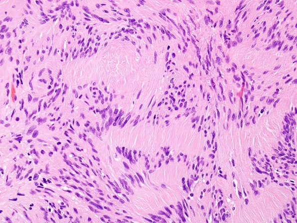 2A4 Schwannoma (Case 2A) H&E 1