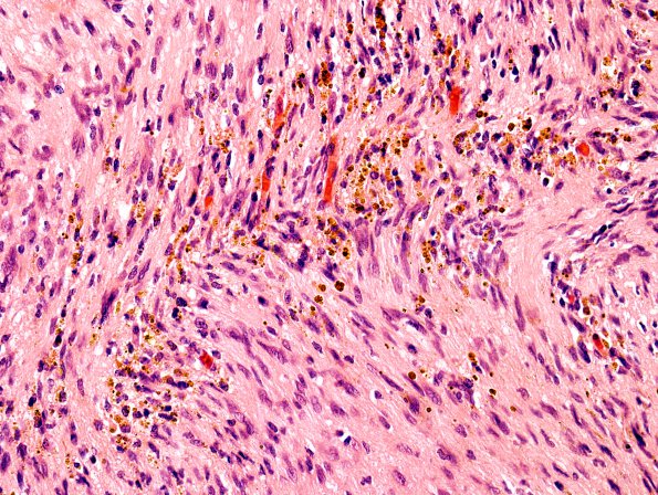 2B2 Schwannoma (Case 2B) hemosiderin