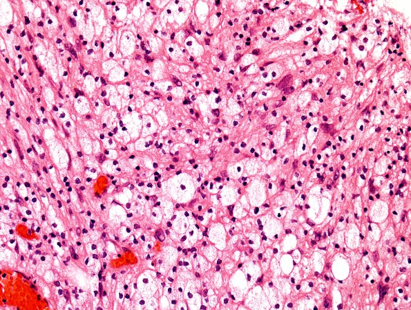 2B3 Schwannoma (Case2B) lipidized cells