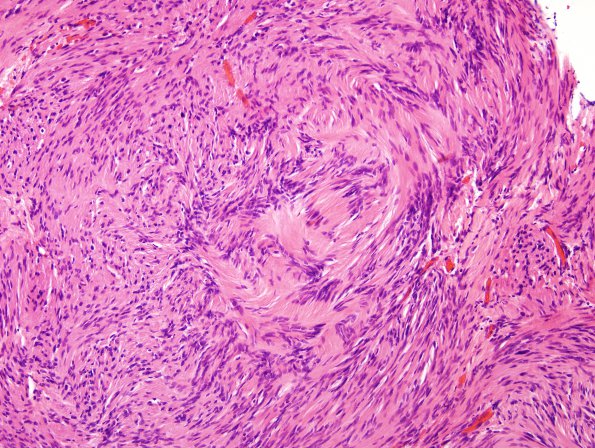 2C1 Schwannoma (Case 2C) H&E 1