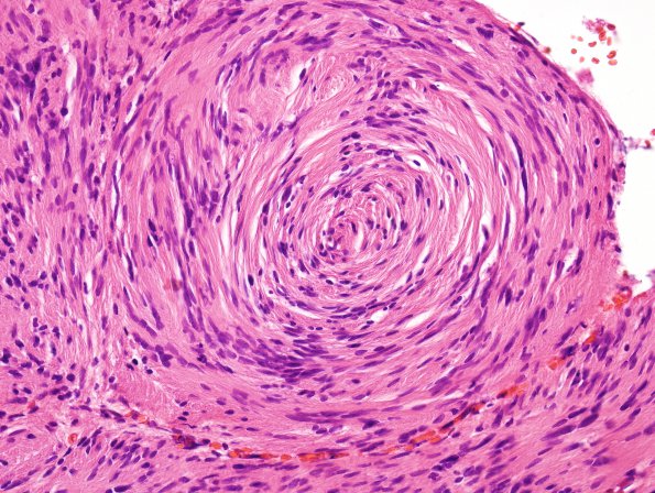 2C2 Schwannoma (Case 2C) H&E 2