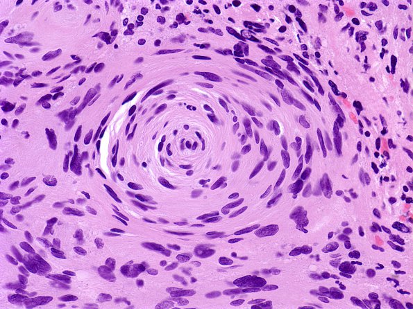 2C3 Schwannoma (Case 2C) whorled