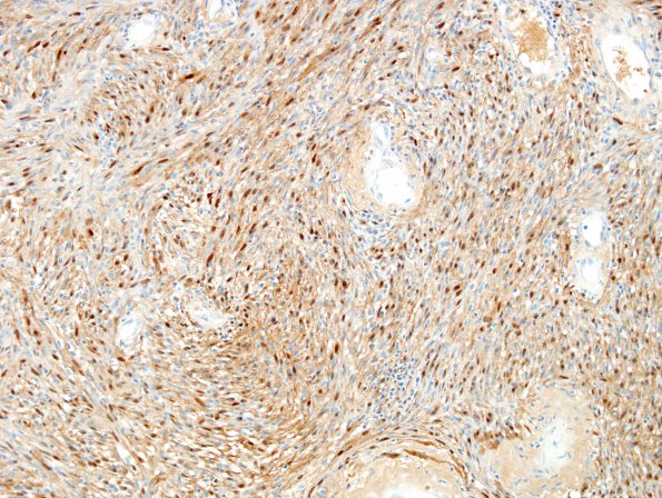 2D Schwannoma (Case 2D) S100 1