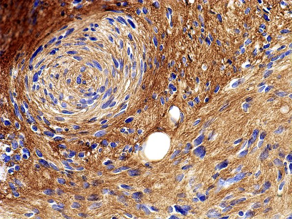 2E2 Schwannoma (Case 2E) whorled Coll IV