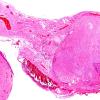 2G1 Schwannoma (Case 2G) H&E