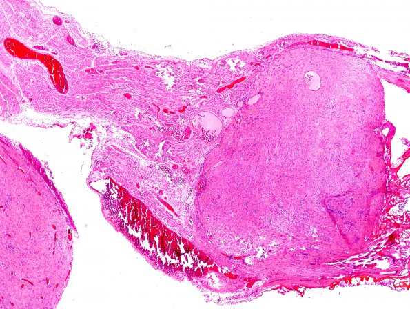 2G1 Schwannoma (Case 2G) H&E