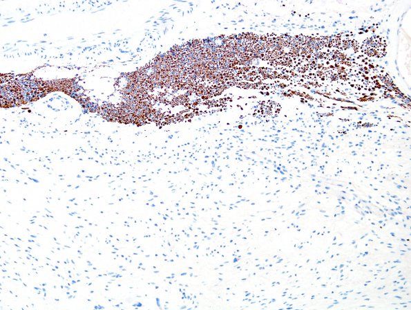 2G3 Schwannoma (Case 2G) NF 1