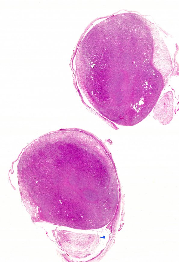 2H Schwannoma, optic nerve, intraneural (Case 2H) whole mount copy