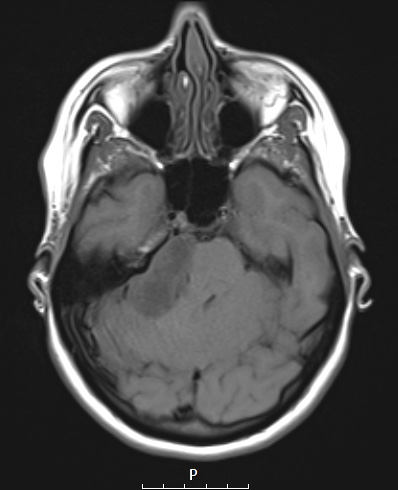 30A1 Schwannoma (Case 30) FLAIR A - Copy