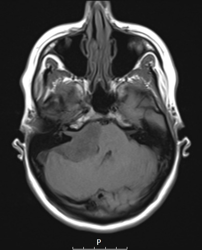 30A2 Schwannoma (Case 30) T1NoC A - Copy