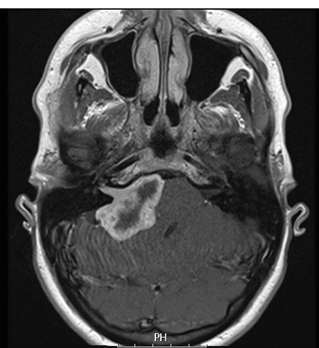 30A3 Schwannoma (Case 30) T1W - Copy