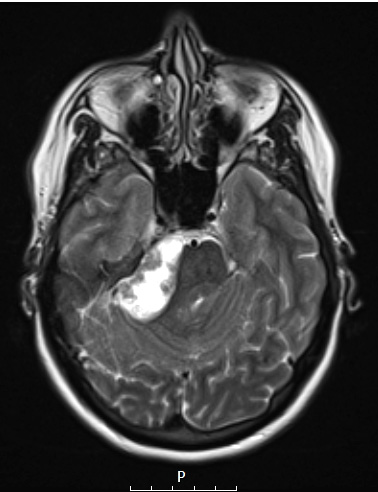 30A4 Schwannoma (Case 30) T2 A - Copy